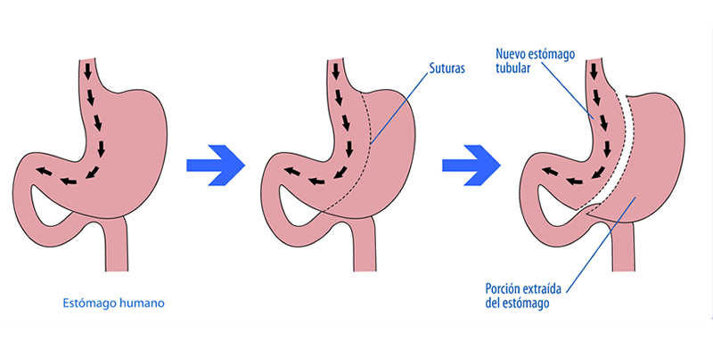 Gastrectomía tubular (SLEEVE)