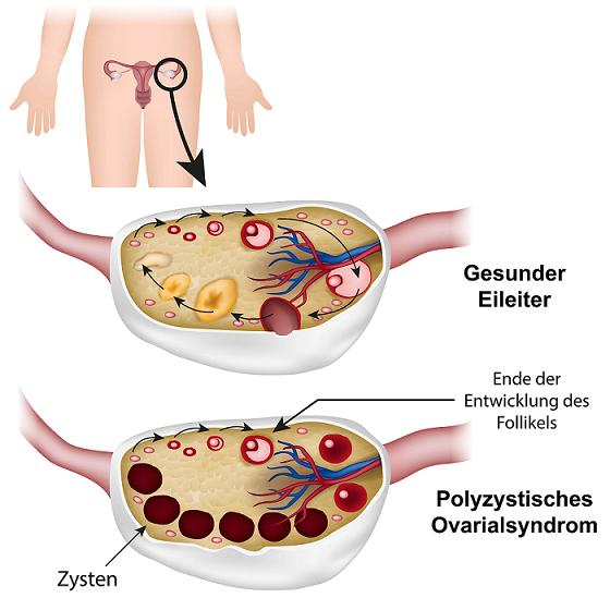 ¿Cuál es la causa del ovario poliquístico?