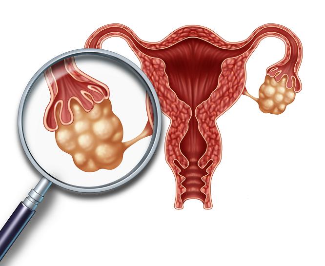 Què es la síndrome de l’ovari poliquístic?